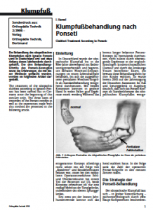 Klumpfußbehandlung nach Ponseti