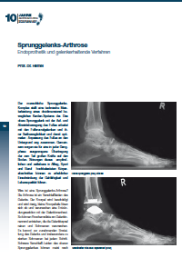 Sprunggelenks-Arthrose